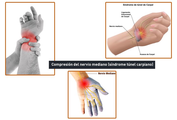 lesion del nervio mediano en la muñeca
