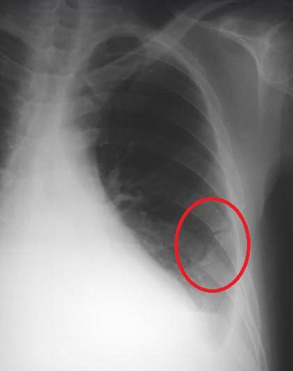 Las costillas del cuerpo humano Costillas fracturadas