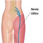 Nervio ciático nervio ciático