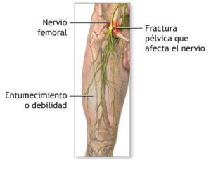 nervio femoral
