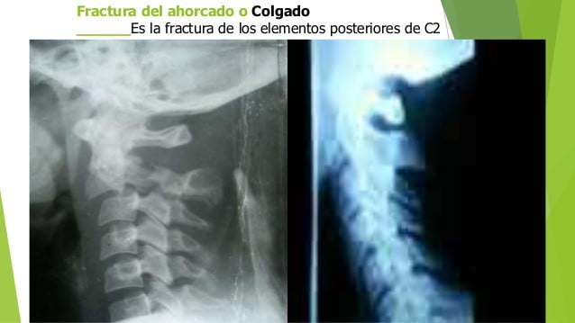 Vértebras cervicales vértebras cervicales