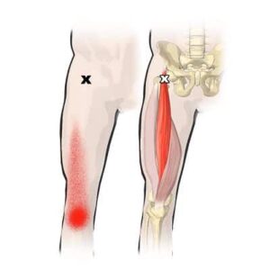 Músculo recto femoral músculo recto femoral