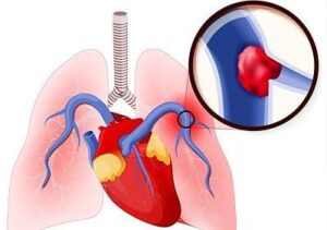 arteria pulmonar