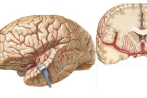 arteria cerebral media