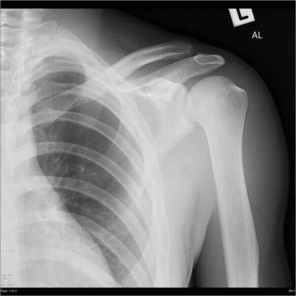 Articulación acromioclavicular Dislocación acromioclavicular