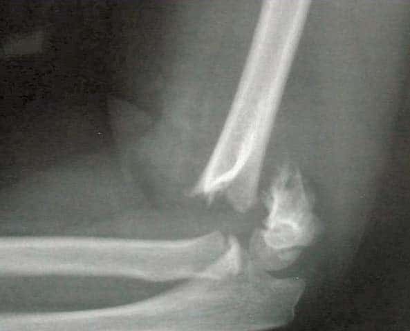 Fosa cubital Radiografía de una fractura humeral supracondilar