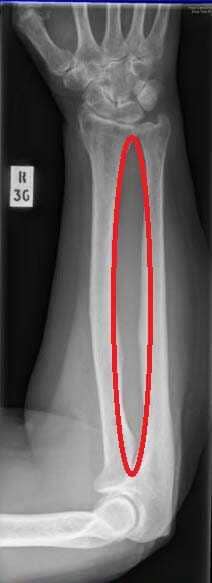 Articulación radioulnar distal Articulación radioulnar distal