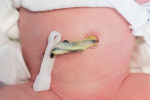 Arteria umbilical Arteria umbilical